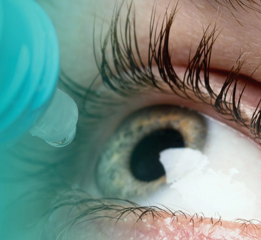 Risk-Factors-for-Developing-a-Chalazion
